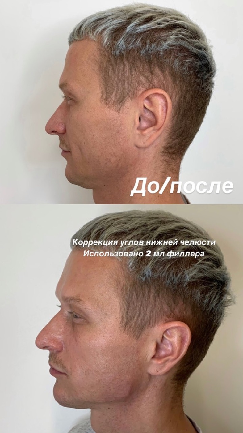 Коррекция углов нижней челюсти