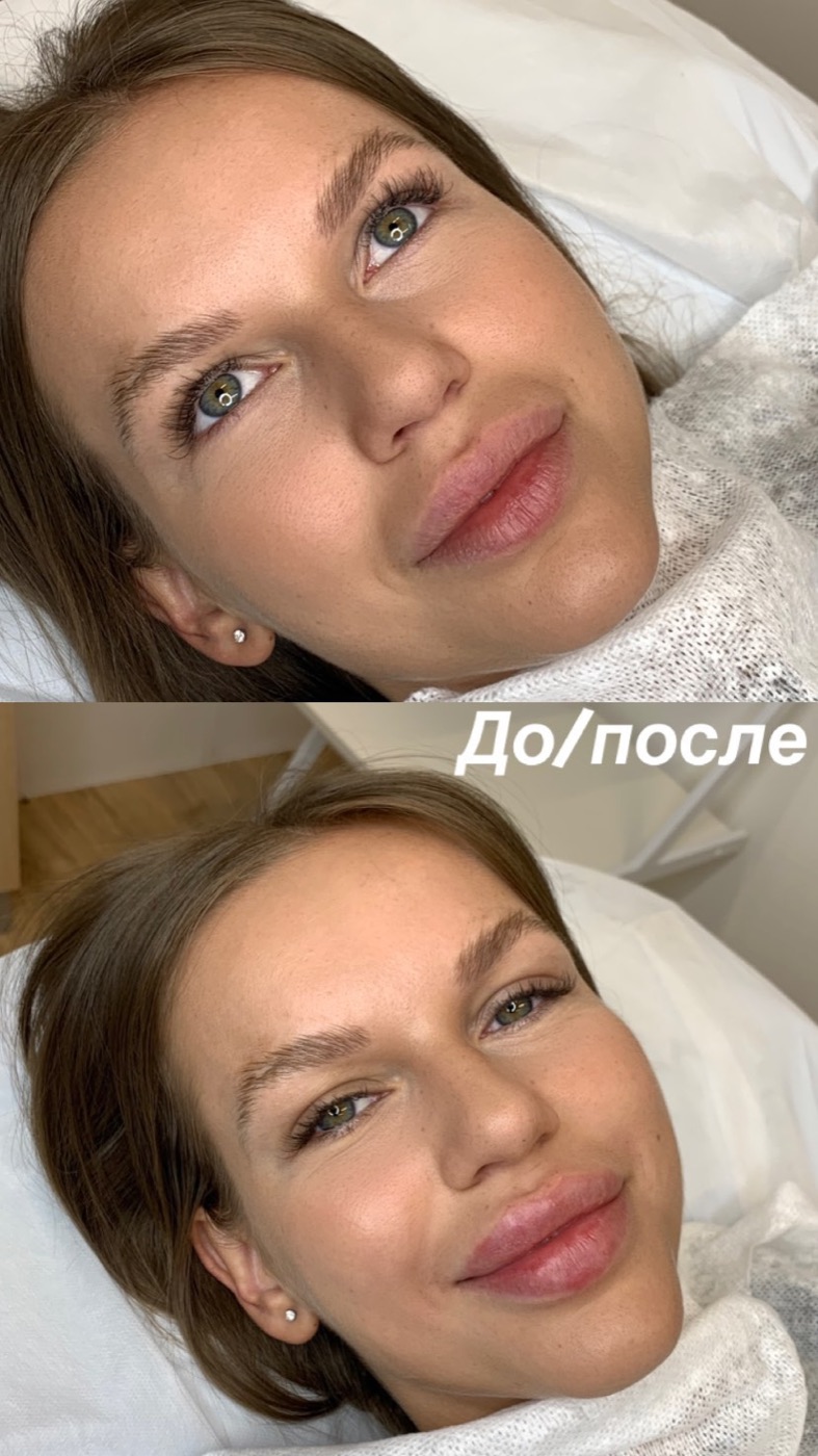 Увеличение губ