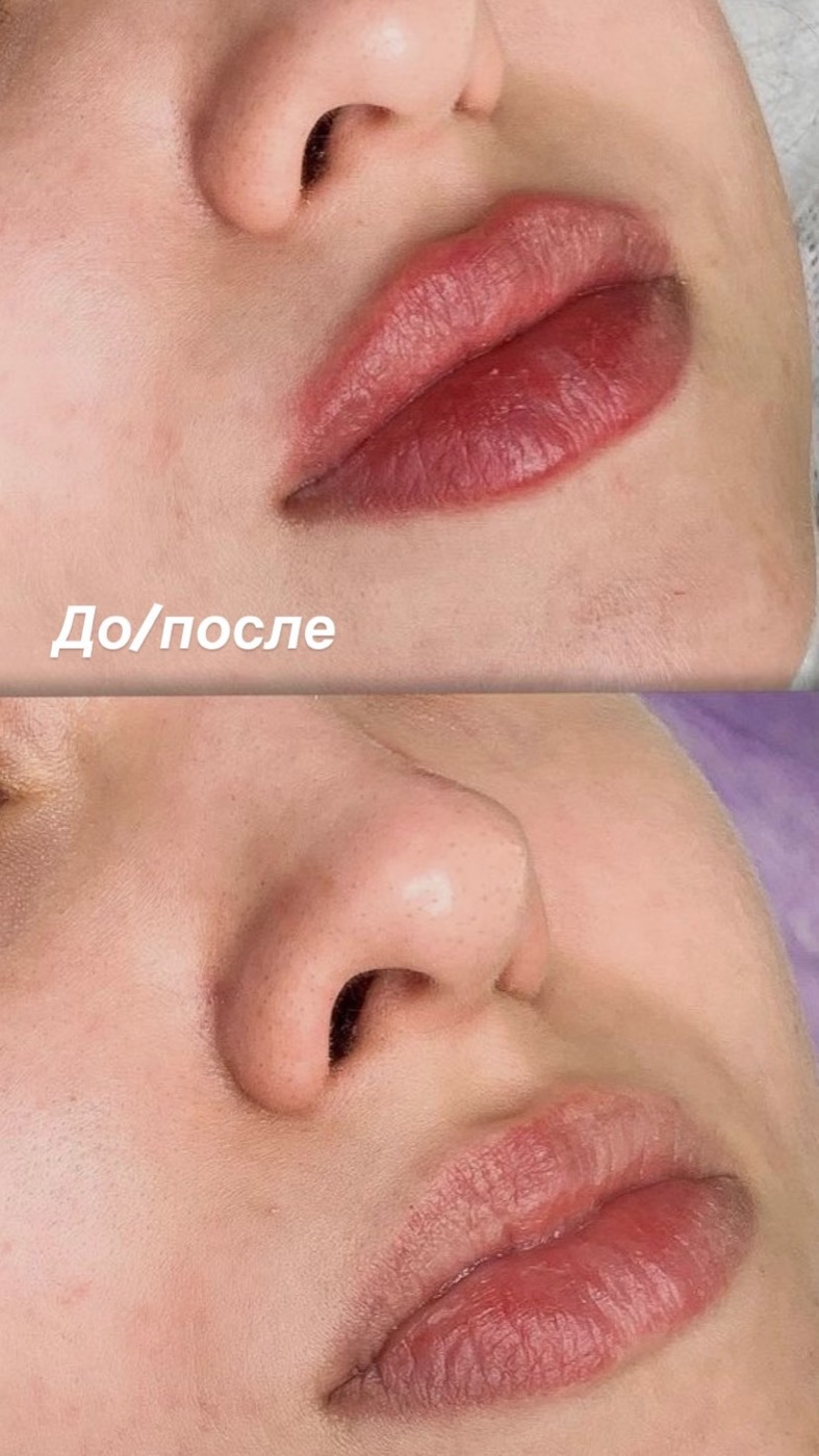 Увеличение губ
