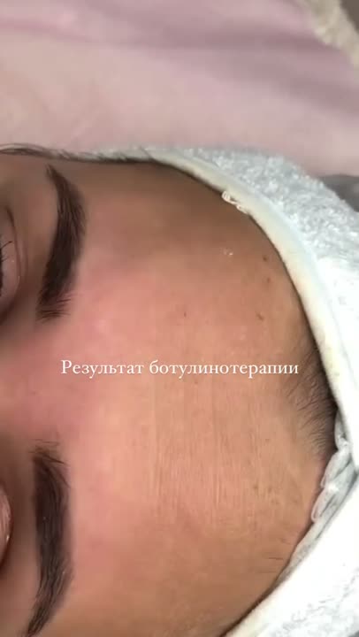 Ботулинотерапия