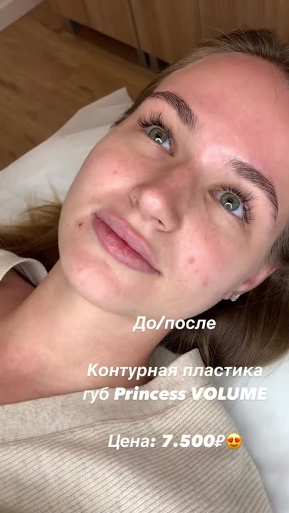 Контурная пластика губ